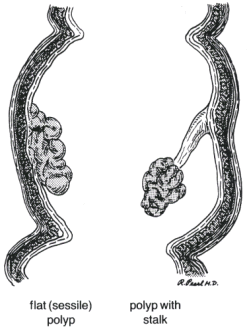 POLYPS THE COLN&RECTUM