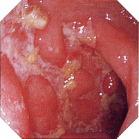 �N���[���a�摜