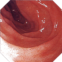 �N���[���a�摜